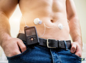 Insulin pump and control connected in the abdomen